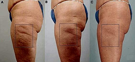 lpg результаты